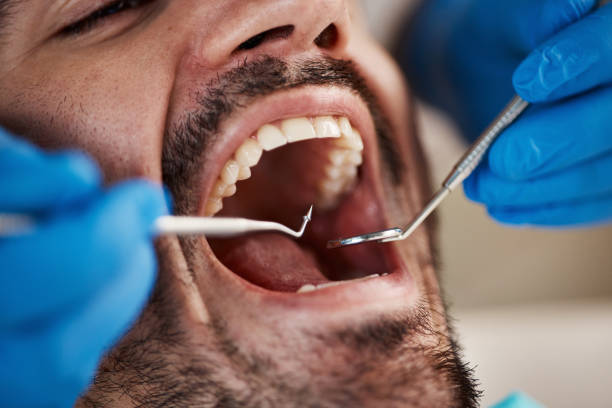 Best Dental Abscess Treatment in Iselin, NJ